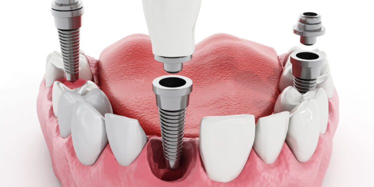 Особенности имплантации зубов