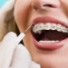 Установка брекетов: показания и назначение