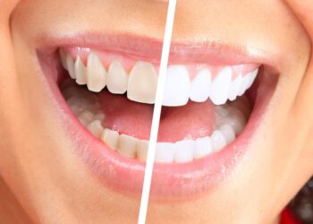 Эффективное отбеливание зубов: мифы, возможности и рекомендации специалистов