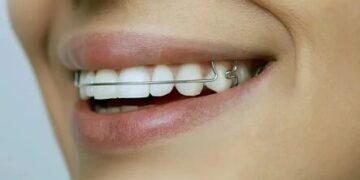 Брекет-системы и ортодонтические пластинки: разница и применение