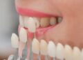 Установка виниров: преимущества, показания, виды и этапы процедуры