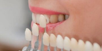 Установка виниров: преимущества, показания, виды и этапы процедуры