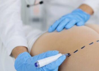 Импланты или липофилинг: что выбрать для увеличения ягодиц в Турции?