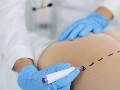 Импланты или липофилинг: что выбрать для увеличения ягодиц в Турции?