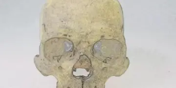 Ученые обнаружили в 4000-летних скелетах из Чили редкую форму проказы