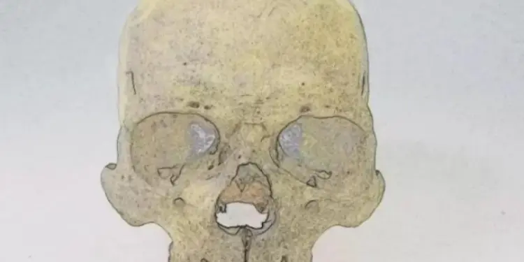 Ученые обнаружили в 4000-летних скелетах из Чили редкую форму проказы