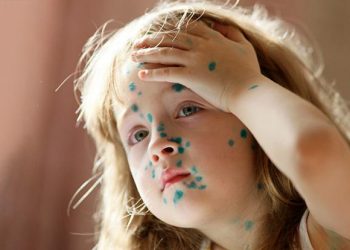 Ветряная оспа в курсе, что с «короной» Минздрав накосячил — и бесчинствует в российских регионах