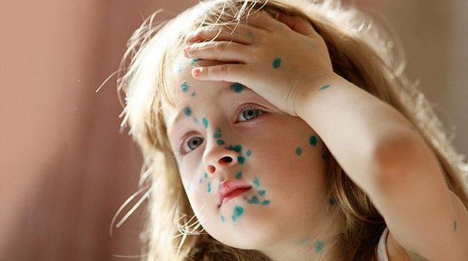 Ветряная оспа в курсе, что с «короной» Минздрав накосячил — и бесчинствует в российских регионах