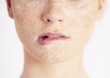 Что нужно знать о лазерной эпиляции при гиперпигментации и склонности к рубцеванию