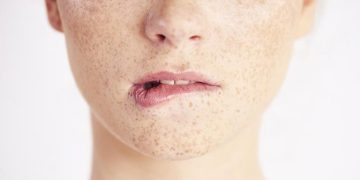 Что нужно знать о лазерной эпиляции при гиперпигментации и склонности к рубцеванию