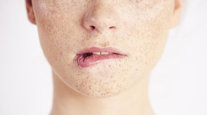 Что нужно знать о лазерной эпиляции при гиперпигментации и склонности к рубцеванию