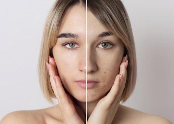 Почему стресс и нарушение сна могут вызывать акне