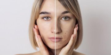 Почему стресс и нарушение сна могут вызывать акне