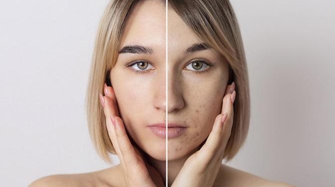 Почему стресс и нарушение сна могут вызывать акне