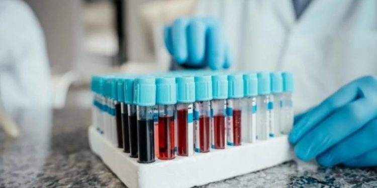 Ученые научились предсказывать смерть человека по одному из анализов крови